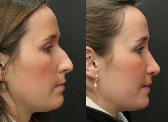 Antes e depois da rinoplastia não cirúrgica