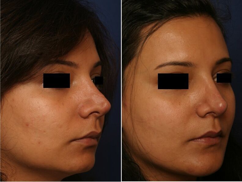 resultado de cirurgia plástica