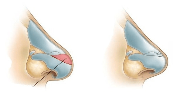 Correção do formato do nariz