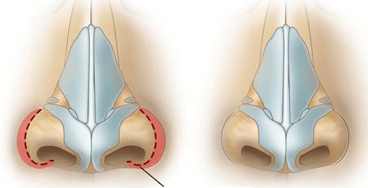 Redução de narinas