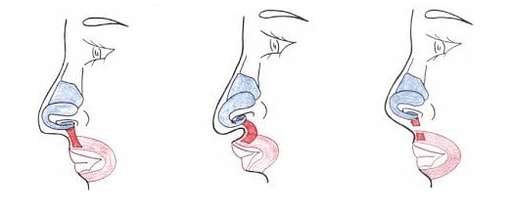 Truncamento de parte do músculo nasal