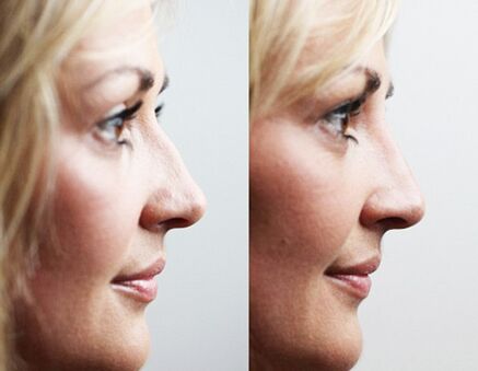 Antes e depois da rinoplastia com preenchimento