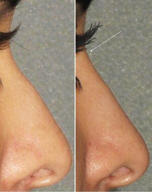 Antes e depois da rinoplastia não cirúrgica
