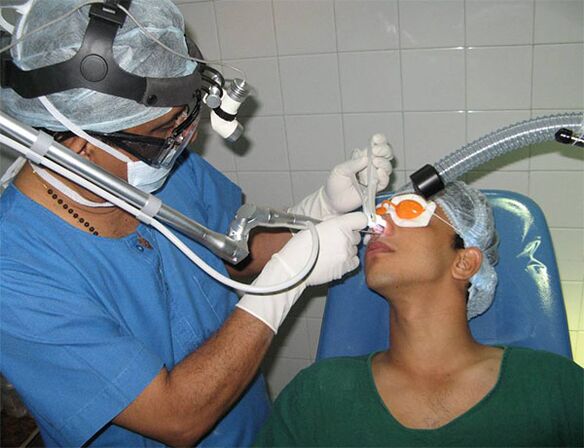 correção do septo com bisturi a laser