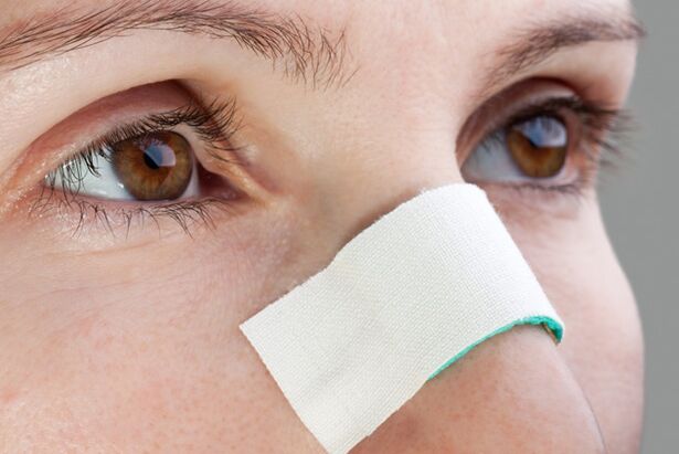 possíveis complicações no pós-operatório de correção do septo nasal