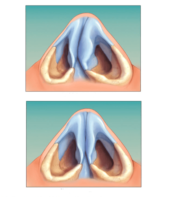 septo nasal corrigido