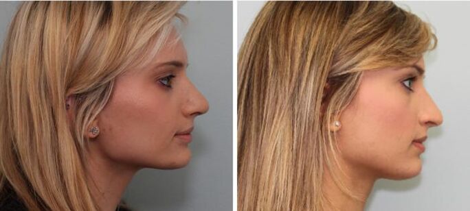 Resultados da rinoplastia antes e depois
