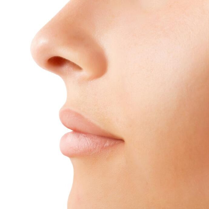 resultado de rinoplastia aberta