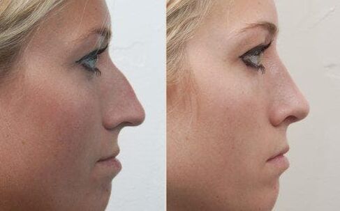 Antes e depois da rinoplastia não cirúrgica