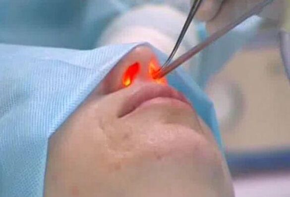 rinoplastia a laser do nariz
