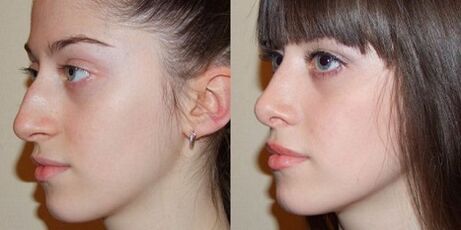 fotos antes e depois da rinoplastia nasal