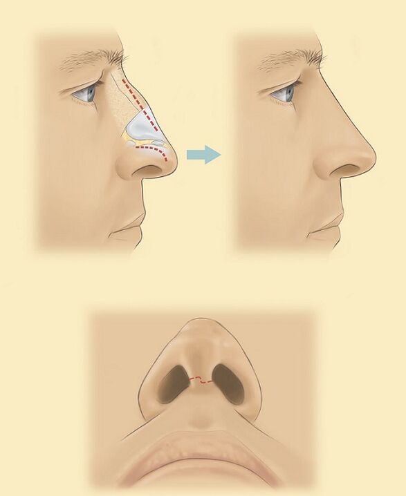 esquema para rinoplastia do nariz