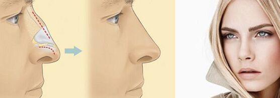 correção do formato do nariz com rinoplastia não cirúrgica