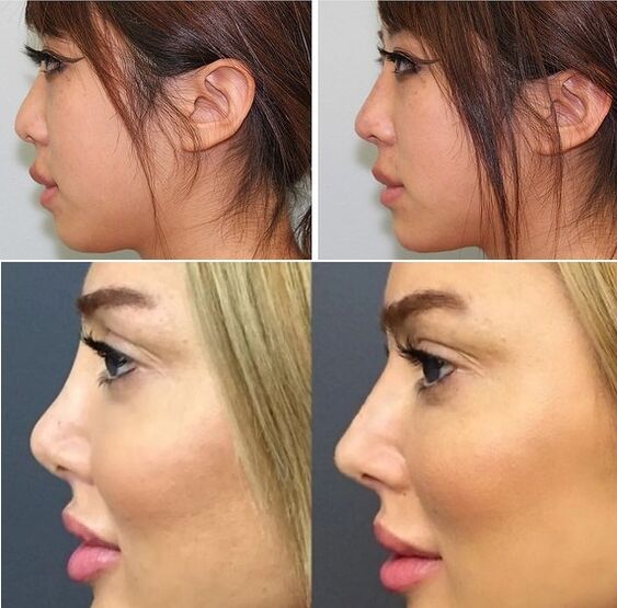 fotos antes e depois da rinoplastia não cirúrgica