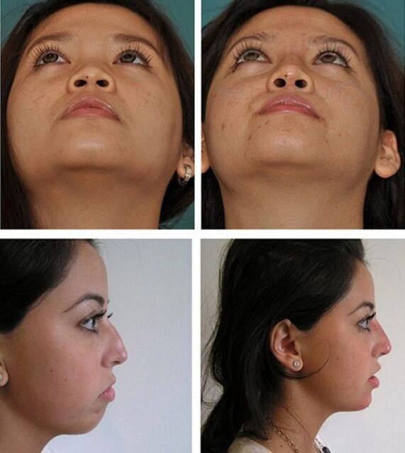 fotos antes e depois da rinoplastia sem cirurgia