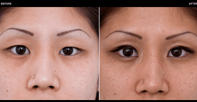 antes e depois da cirurgia ocular