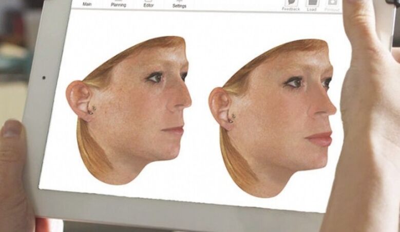 Método de modelagem computacional do nariz antes da rinoplastia