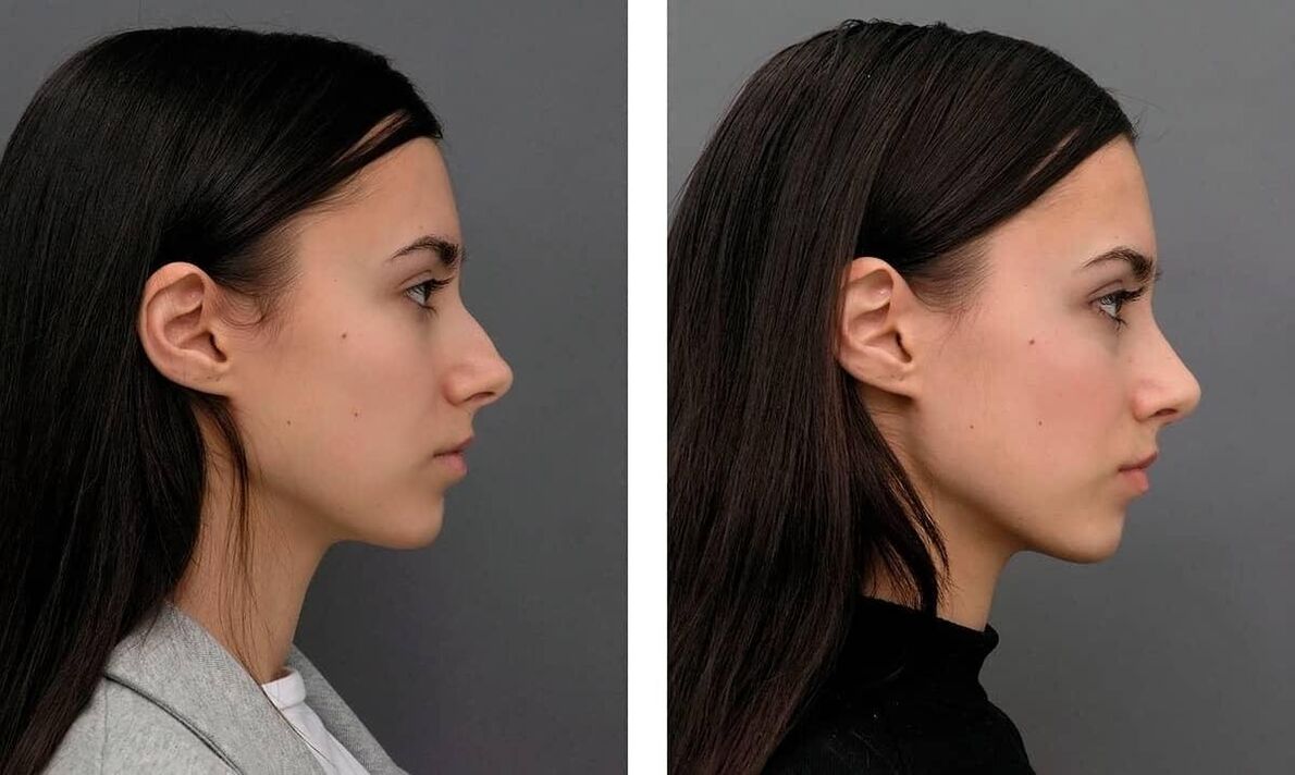 fotos antes e depois da rinoplastia