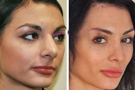 nariz antes e depois da cirurgia plástica