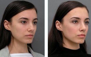 A menina de antes e depois da rhinoplasty do nariz